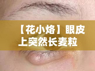 【花小烙】眼皮上突然长麦粒肿？别慌，真相让你直呼“离谱”！